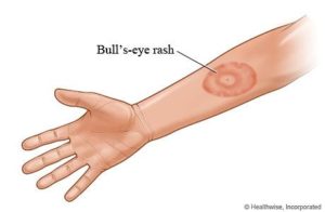 picture of Bull's-eye rash